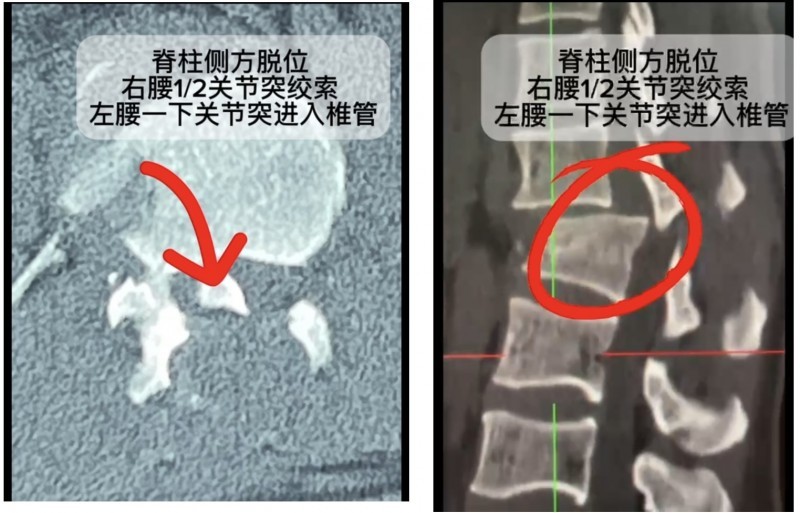 湖州邦尔骨科医院拯救一例肩关节脱位患者