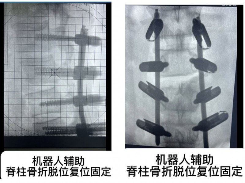 湖州邦尔骨科医院拯救一例肩关节脱位患者